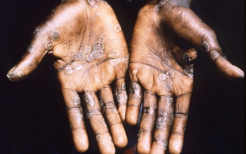 Lòng bàn tay của 1 bệnh nhân mắc bệnh đậu mùa khỉ ở Lodja, Cộng hòa dân chủ Congo. (Ảnh: CDC/Reuters)