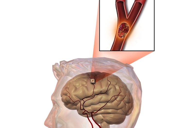 Nhồi máu não chiếm tỷ lệ khoảng 80-85% đột quỵ não